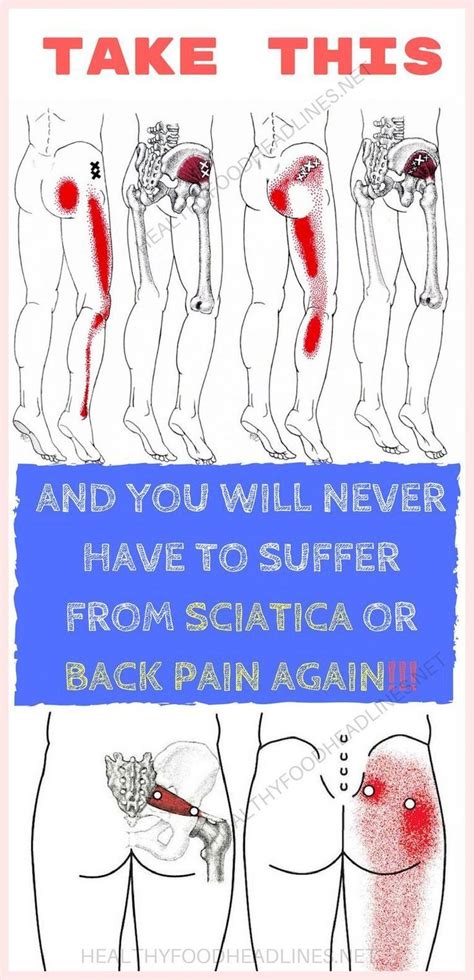 If You Have Sciatica Or Back Pain Take This Remedy And Youll Never