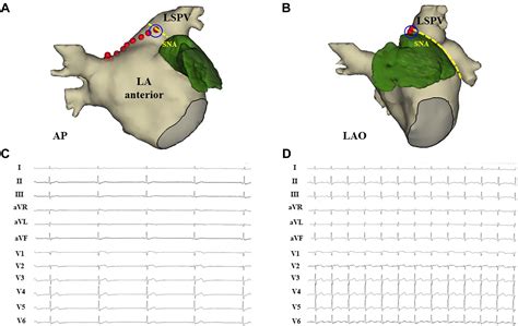 Sinus Node Dysfunction Caused By A Sinus Node Artery Occlusion During