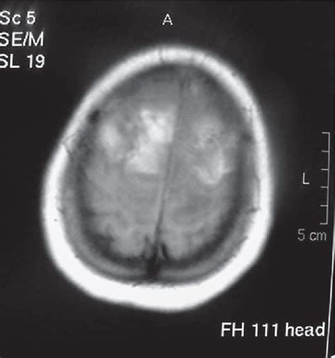 Figure From Cranial Thromboembolism Secondary To Patent Foramen Ovale