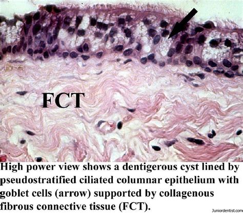 Dentigerous Cyst Definition Clinical Features Types Radiographic