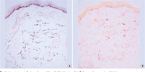 Figure 2 From Comparison Of Characteristics Of Acquired Bilateral Nevus