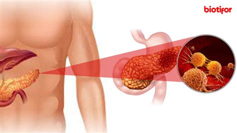 Mengenal Kanker Pankreas Penyebab Gejala Dan Pengobatan Biotifor