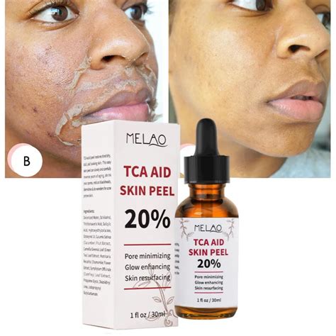 Tca Aid Skin Peel Pores Ml Trichloroacetic Acid Stock Solution