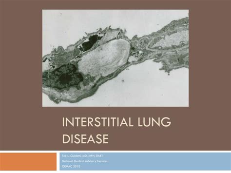 Ppt Interstitial Lung Disease Powerpoint Presentation Free Download Id177434