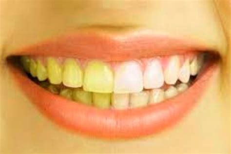 Nine Natural Remedies To Prevent Yellow Teeth