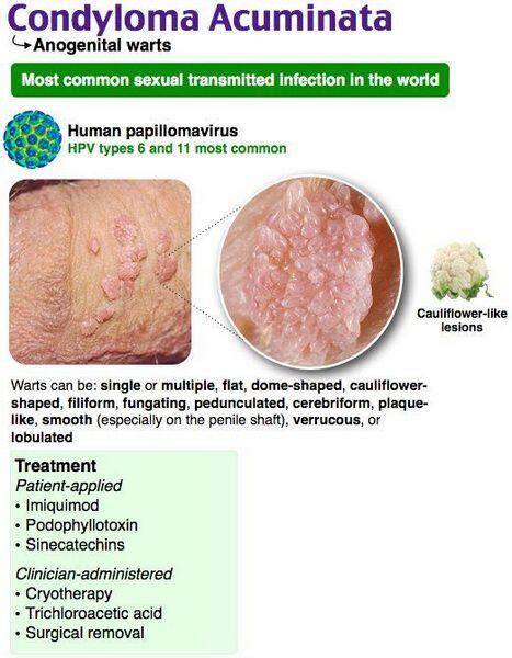 Condyloma Lata Vs Condyloma Accuminata