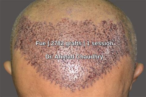 Hair Transplant Riyadh Patient 2782 Fue Grafts Free Estimate Contact Us