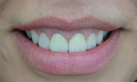 Laser Gum Lifts And Gum Reshaping Adelaide Cosmetic Dentistry