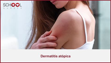 Dermatitis Atópica Qué Es Causas Y Síntomas School Nurses