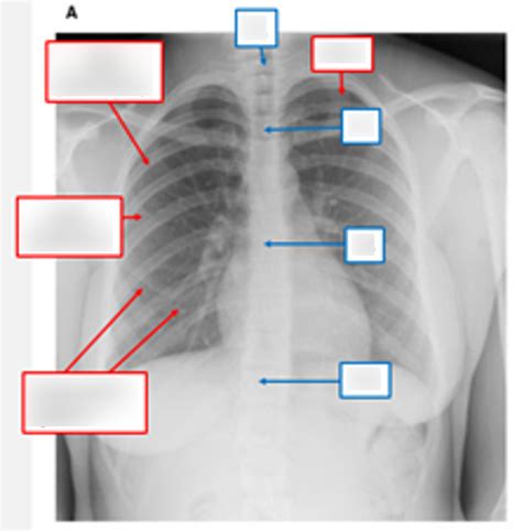 Chest X Ray Diagram Quizlet