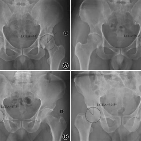 Preoperative And Postoperative Ap Radiographs Of The Pelvis In The High