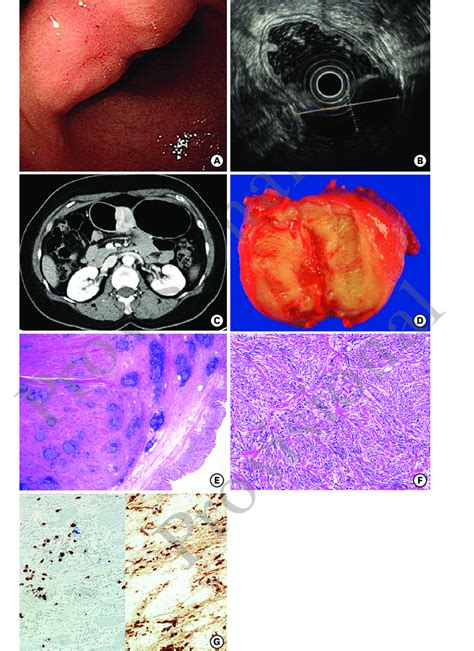 Case 1 A Endoscopy A 4 Cm Sized Fixed And Hard Submucosal Lesion At Download Scientific