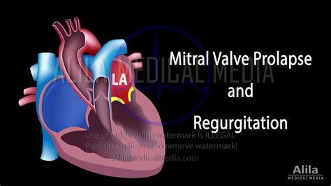 Alila Medical Media Mitral Valve Prolapse And Regurgitation Narrated