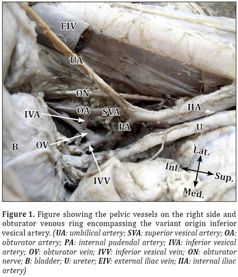 Obturator Venous Ring Encompassing The Variant Origin Inferior Vesical