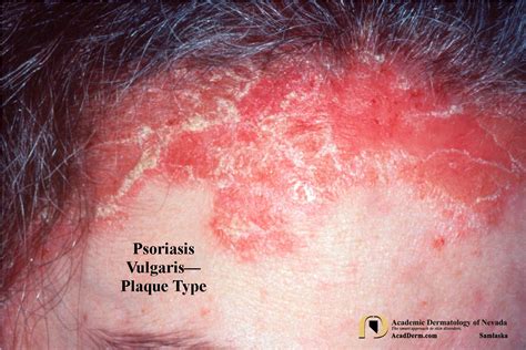 Psoriasis Vulgaris The Basics Academic Dermatology Of Nevada