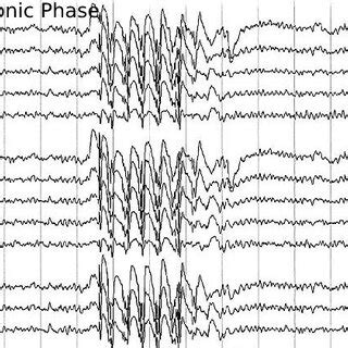 An Ictal Electroencephalogram EEG Showing 1 Hz Spike Wave Pattern