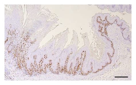 Mucosal Hyperplasia And Squamous Cell Carcinoma Induced By C Albicans