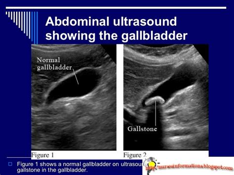 Abdominal Ultrasound