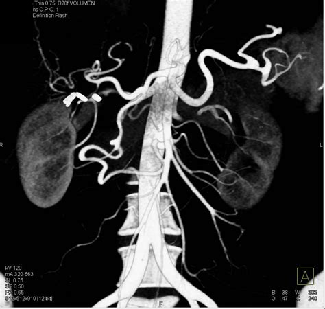 Celiac Artery Vasculitis Radiology