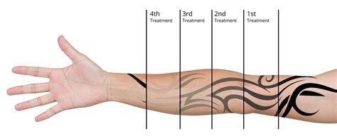 how to remove tattoo ink from skin at home