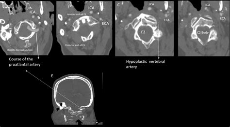 Mechanical Thrombectomy In Basilar Artery Stroke Attributable To