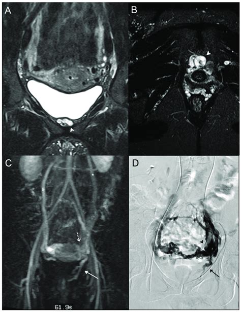 A 38 Year Old Woman Who Suffered From Recurrent Varicose Veins In The