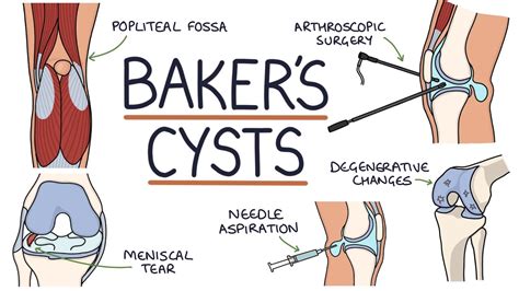 Understanding Baker S Cysts Popliteal Cysts Youtube