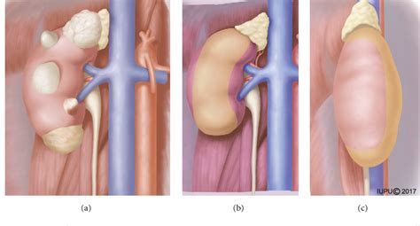 Figure 1 From The Application Of Internal Suspension Technique In