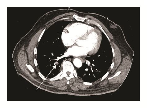 Splenic Infarct And Pulmonary Embolism As A Rare Manifestation Of