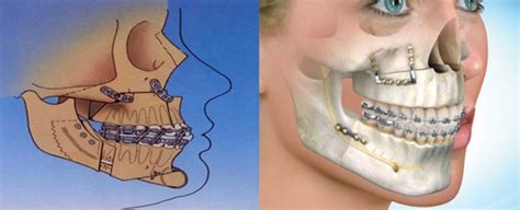 Corrective Jaw Surgery In Ventura CA Orthognathic Surgery