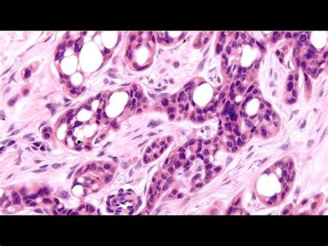 Primary Cutaneous Cribriform Carcinoma McKee YouTube