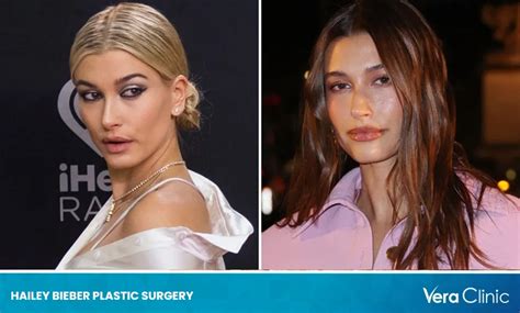 Hailey Bieber Plastic Surgery The Evolution Of Beauty