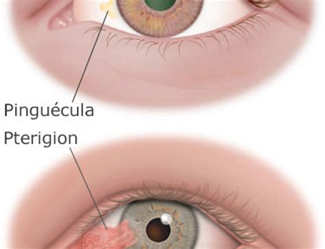 Carnosidad En El Ojo O Pterigion
