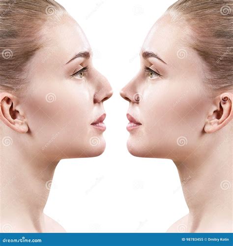 Female Nose before and after Cosmetic Surgery. Stock Image - Image of ...