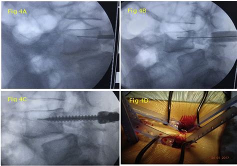 Figure 4 From Minimally Invasive Transforaminal Lumbar Interbody Fusion Mi Tlif A Review Of