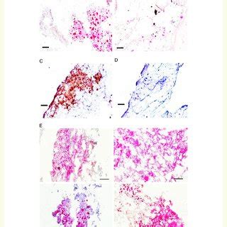 Representative Examples Of Histological Findings In Thrombectomy