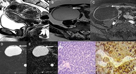 Figure 1 From Characterization Of Ovarian Granulosa Cell Tumors Using