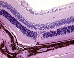 Bruch's Membrane - What it Means to your Macular Health