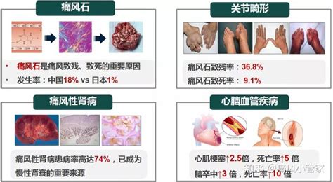 2019中国高尿酸血症与痛风诊疗指南解读 知乎