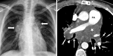 Mediastinal Masses Radiology Key