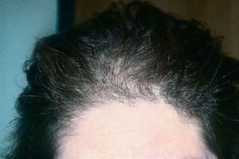 Hair And Scalp Disorders Resulting In Hair Loss Plastic Surgery Key