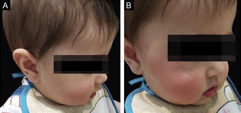 Scielo Brasil Case For Diagnosis A Transient Unilateral Face Rash