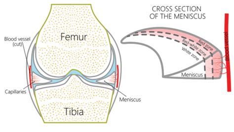 Meniscus Tear Recovery Tme Without Surgery Regenexx