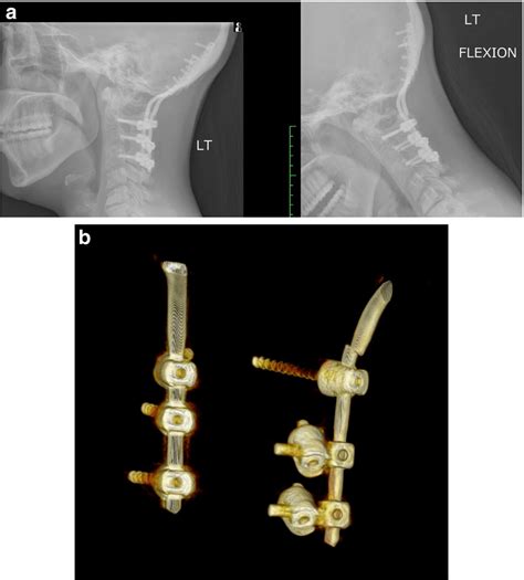 A X Rays Cervical Spine In Flexion And Extension Lateral View Of Download Scientific Diagram