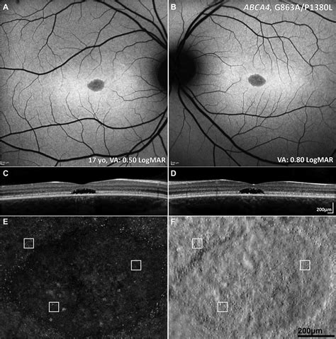 Macular Dystrophies Clinical And Imaging Features Molecular Genetics