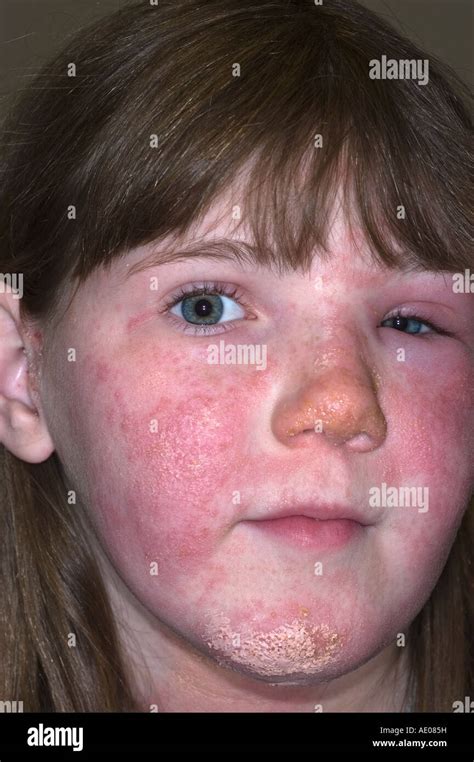 Young Girl With Poison Ivy Rash On Her Face Which She Is Treating With