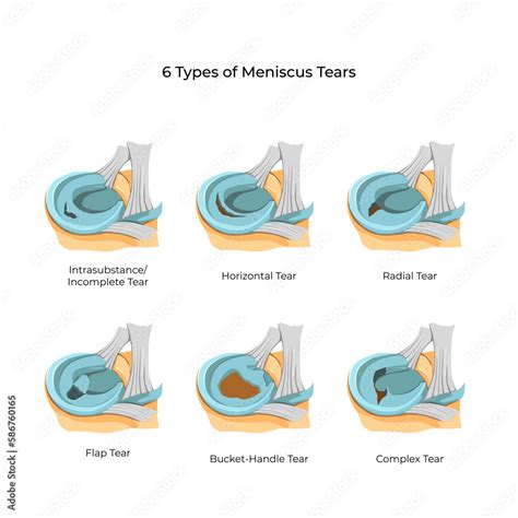 Vector Illustration 6 Types Of Meniscus Tears Stock Vector Adobe Stock