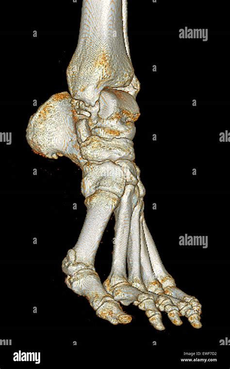Pie de tomografía computarizada fotografías e imágenes de alta