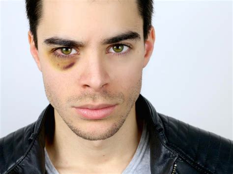 Black Eye Causes Symptoms Diagnosis And Treatment