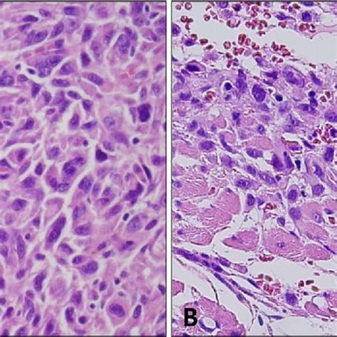 Pleomorphic Dermal Sarcoma A High Power View Reveals Frequent